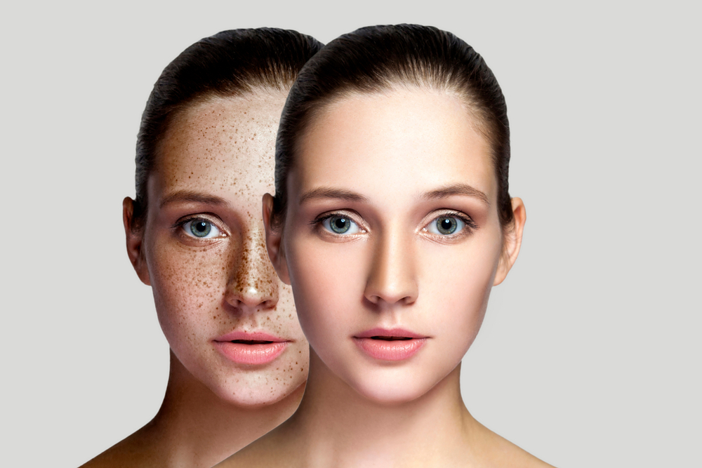Pigmentation Laser Treatment: Your Road to Clear, Spotless Skin